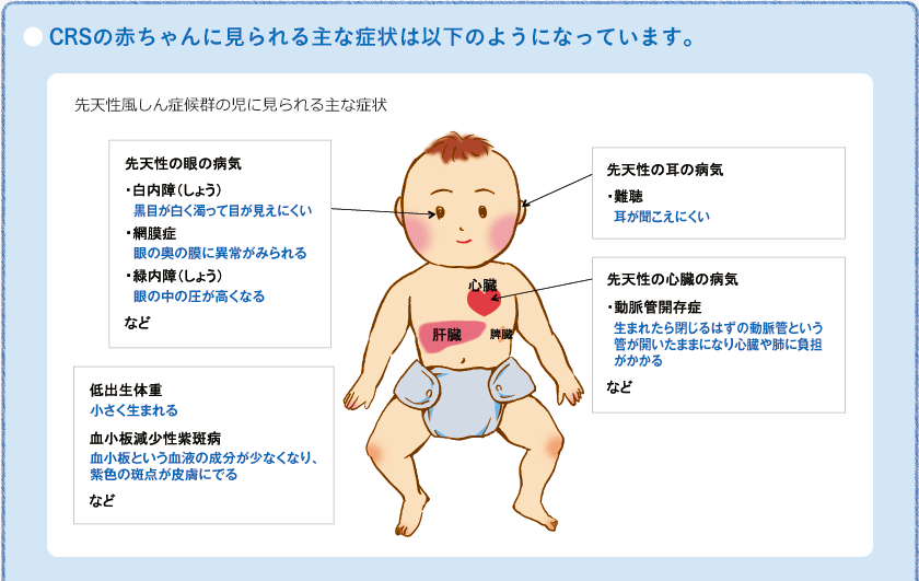 先天性風疹症候群に罹った赤ちゃん